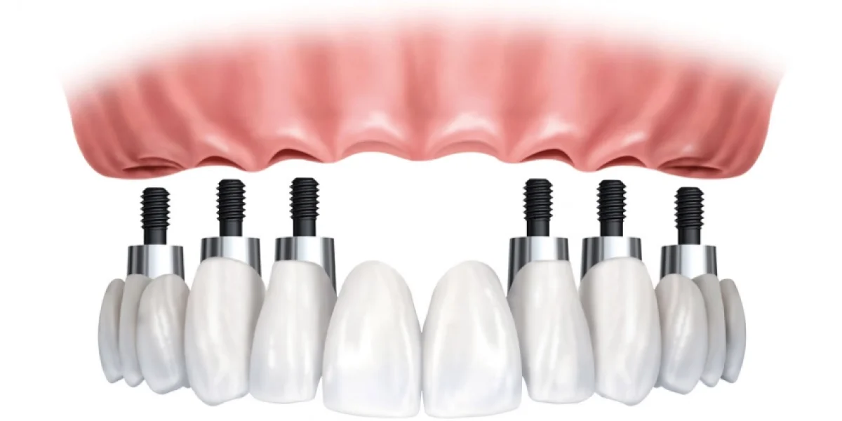 Тотальное протезирование зубов: особенности, виды и этапы процедуры