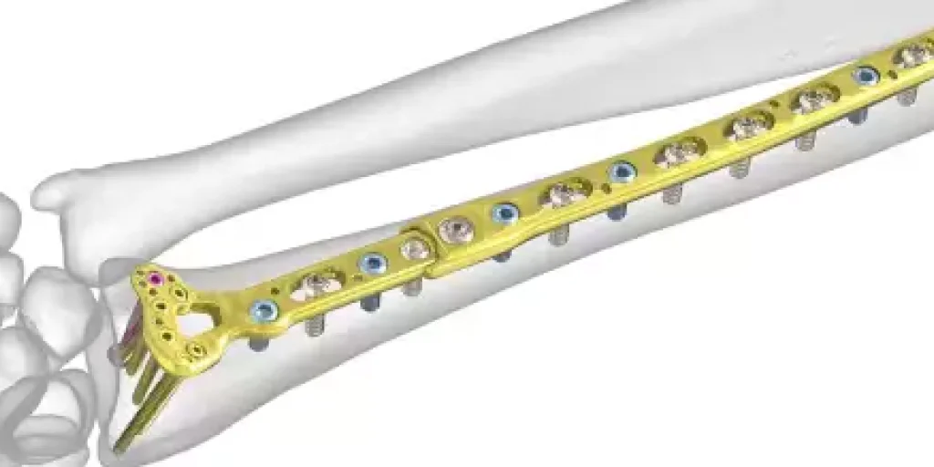 Титановая пластина на руку