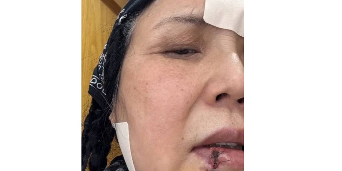 Звезда &laquo;Битвы экстрасенсов&raquo; Лилия Хегай показала изуродованное лицо после нападения собственной собаки (ФОТО)